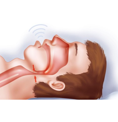 How common is  sleep apnea?